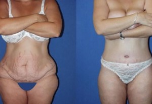 Find the Best Abdominoplasty Surgeon in Miami