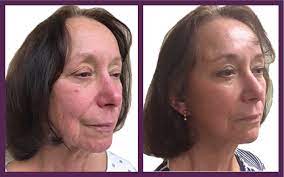 Mini Neck Lift Near Me: Transforming Your Appearance