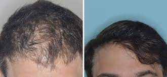 Miami’s Hair Renaissance: Cutting-Edge Hair Restoration Techniques Unveiled